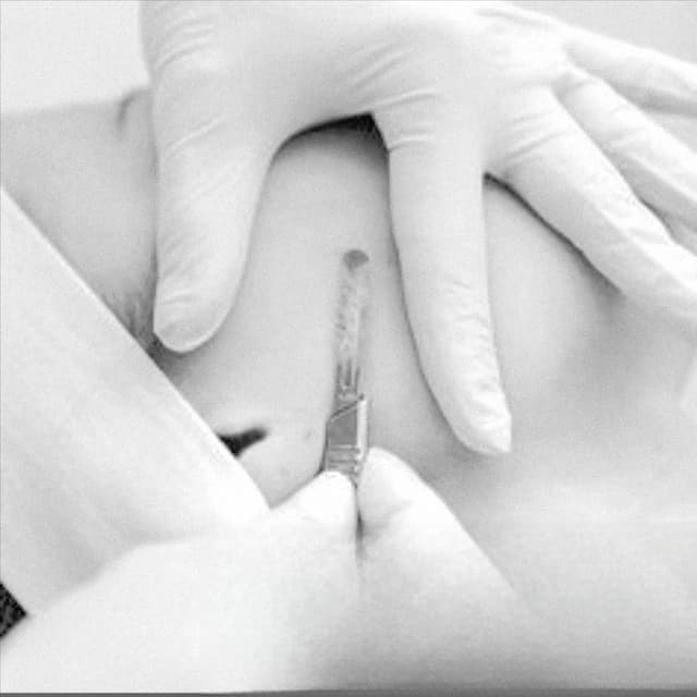 Dermaplaning Facial Package at Elite Esthetics Beauty & Wellness Studio, LLC in Turlock, CA
